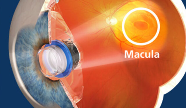 Macular Degeneration What You Need to Know Columbus